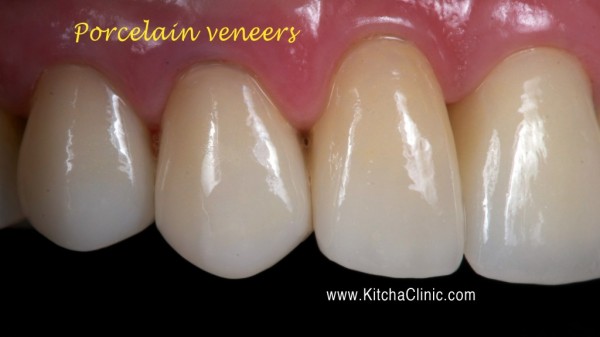 Kitcha Dental Clinic Chiang Mai Thailand dentist implant veneer crown bridge ทำฟัน จัดฟัน ฟอกสีฟัน รากเทียม