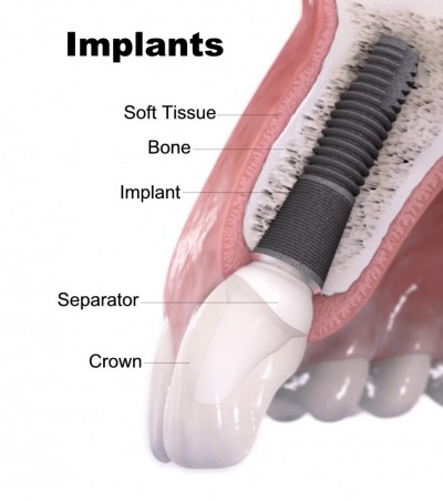 Kitcha Dental Clinic Chiang Mai Thailand dentist implant veneer crown bridge ทำฟัน จัดฟัน ฟอกสีฟัน รากเทียม