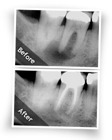 endodontic