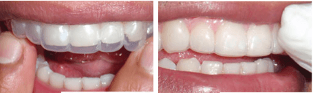 Delivering bleaching tray