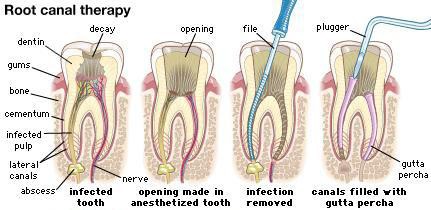 rootcanal