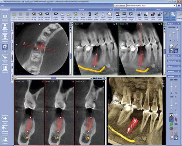 kitcha dental implant