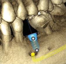 kitcha dental implant