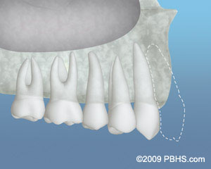 Inadequate Bone before Bone graft