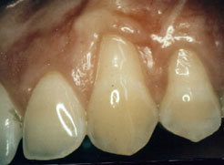 Before gum grafting at chiangmai dental clinic