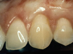After gum grafting at thailand dental clinic