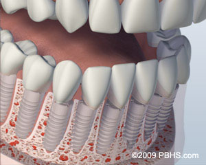 Kitcha Dental Clinic Chiang Mai Thailand dentist implant veneer crown bridge ทำฟัน จัดฟัน ฟอกสีฟัน รากเทียม