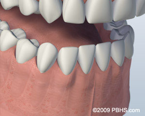 Kitcha Dental Clinic Chiang Mai Thailand dentist implant veneer crown bridge ทำฟัน จัดฟัน ฟอกสีฟัน รากเทียม