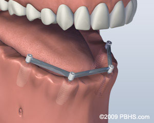 Kitcha Dental Clinic Chiang Mai Thailand dentist implant veneer crown bridge ทำฟัน จัดฟัน ฟอกสีฟัน รากเทียม