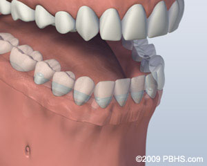Kitcha Dental Clinic Chiang Mai Thailand dentist implant veneer crown bridge ทำฟัน จัดฟัน ฟอกสีฟัน รากเทียม