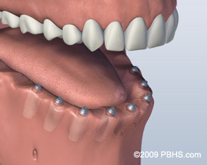 Kitcha Dental Clinic Chiang Mai Thailand dentist implant veneer crown bridge ทำฟัน จัดฟัน ฟอกสีฟัน รากเทียม