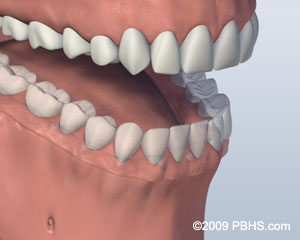 Kitcha Dental Clinic Chiang Mai Thailand dentist implant veneer crown bridge ทำฟัน จัดฟัน ฟอกสีฟัน รากเทียม