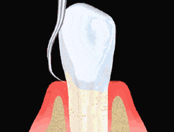 Scaling at Chiangmai Dental Clinic
