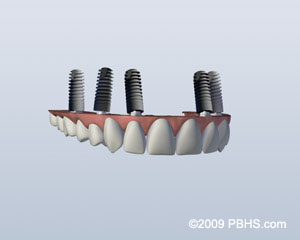 Implant retained upper denture