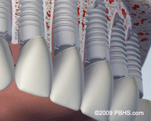 Individual Upper Dental Implants Individual Upper Dental Implants