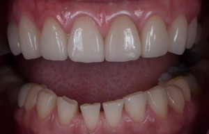 Porcelain veneer result at Kitcha Dental in Chiang Mai