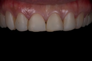 kitcha chiang mai dental clinic veneer