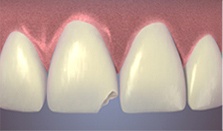 chipped-tooth