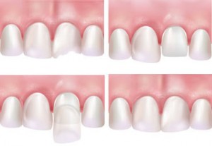 kitcha-dental-veneers
