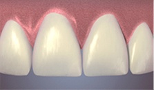 tooth-after-bonding-repair