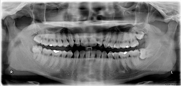 Impacted_wisdom_teeth