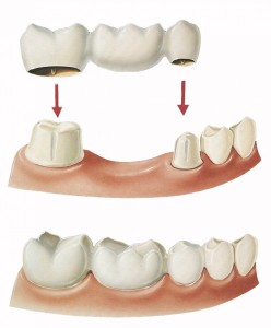 kitcha_dental_clinic_chiang_mai_bridge