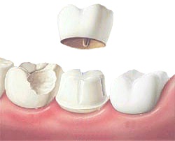 kitcha_dental_clinic_chiang_mai_crown