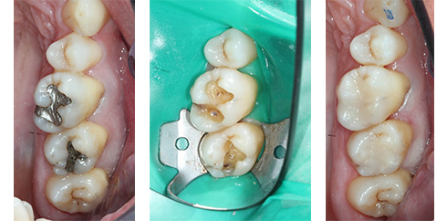 Kitcha Dental Clinic Chiang Mai Thailand dentist implant veneer crown bridge ทำฟัน จัดฟัน ฟอกสีฟัน รากเทียม
